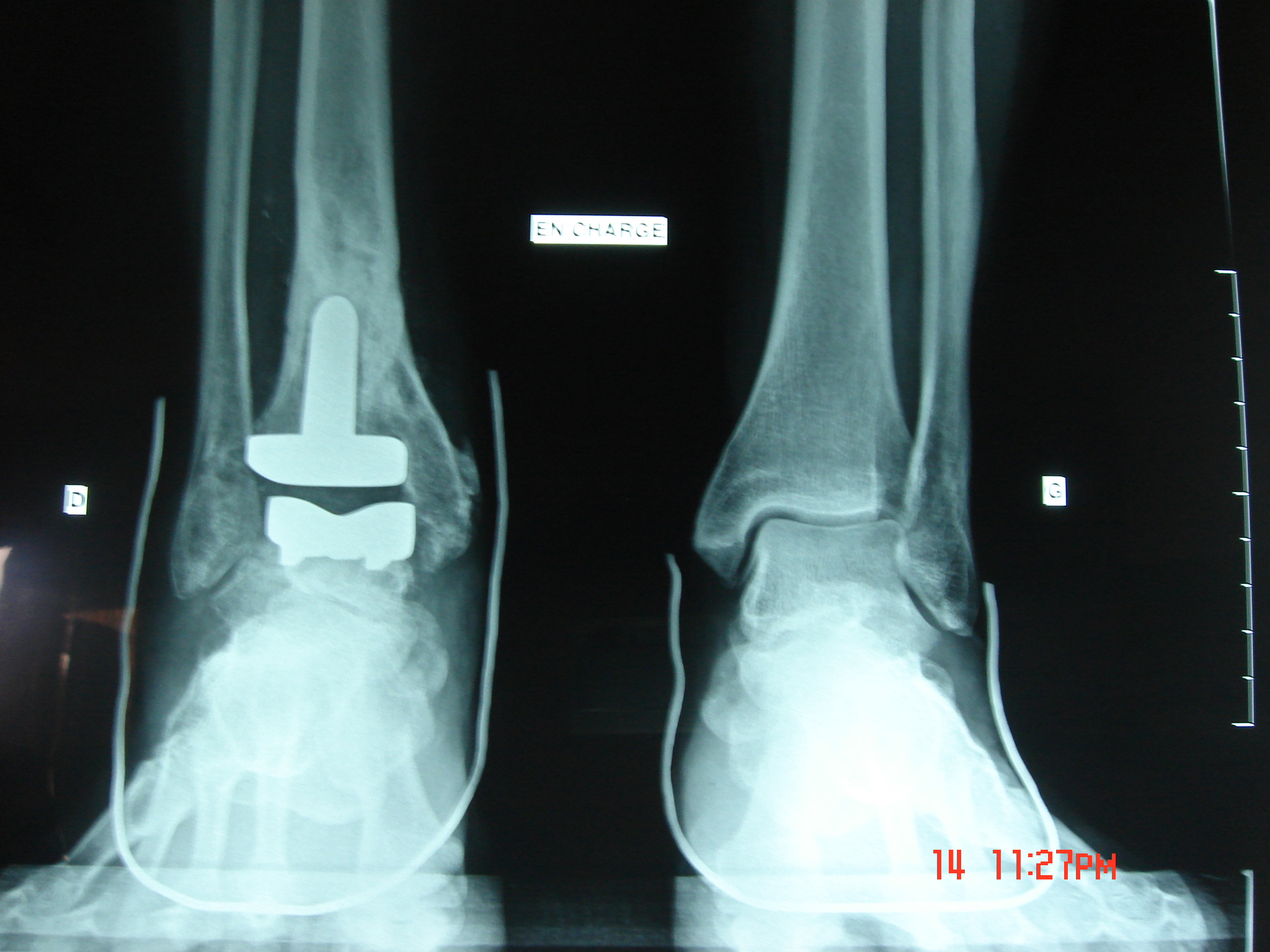 osteotomie supramall olaire